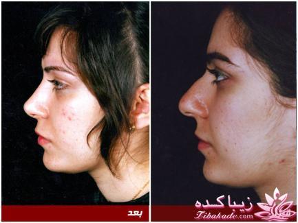 جراحی بینی - جراحی زیبایی